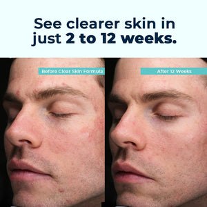 VitaMedica Clear Skin Vitamin Formula | Noncystic Acne Supplement for Skin Clearing | Breakout Treatment for Women and Men | Vitamins A, C, E, Selenium, Chromium, and Zinc for Skin Health | 2 Pack VitaMedicaBuy Supplements Australia