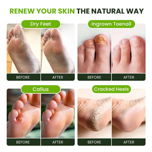 FOOT CURE Tea Tree Oil Foot Soak with Epsom Salt - Best Toenail Fungus Treatment, Athletes Foot & Softens Calluses - Soothes Sore & Tired Feet, Fungal Toe, Foot Odor Scent, Spa Pedicure (Pack of 2) FOOT CURE buy supplements Au