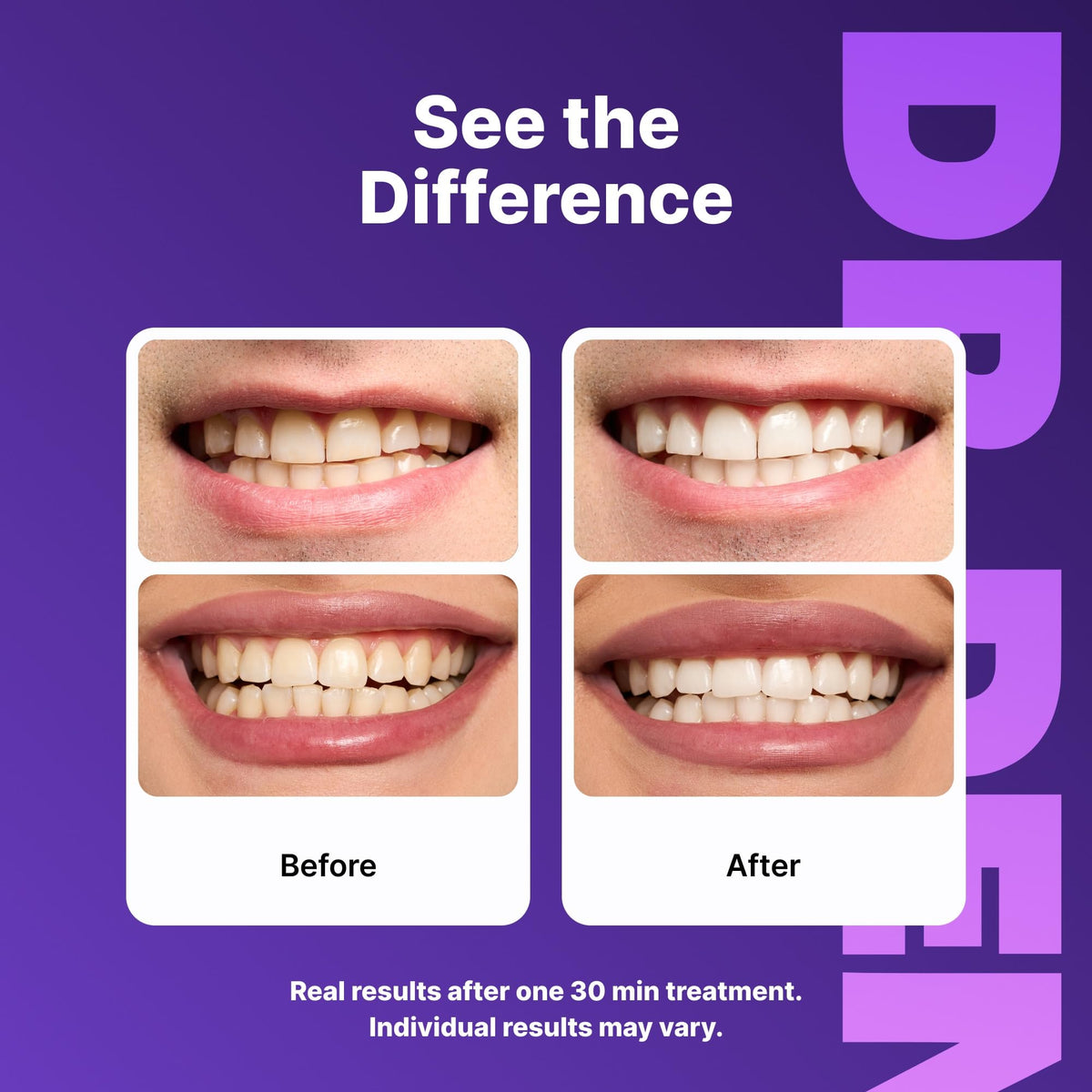 Suplement ​DRDENT Purple Teeth Whitening Strips 21 Treatments - Safe for Enamel - Non Sensitive Teeth Whitening - VelvetGlow USA